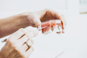 les implant dentaires