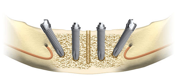 All-on-4-Pontault-Combault-Mandibule All on 4 Pontault-Combault