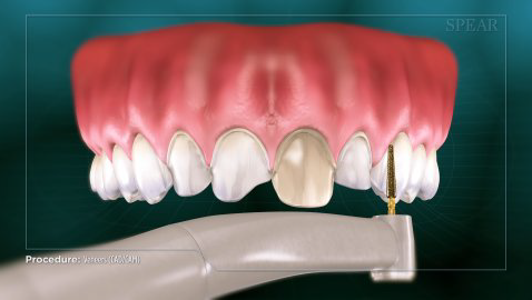 Facette-dentaire-2