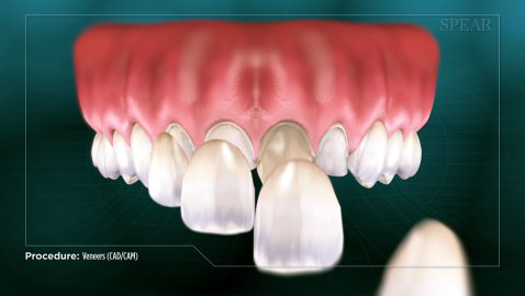 Facette-dentaire-3