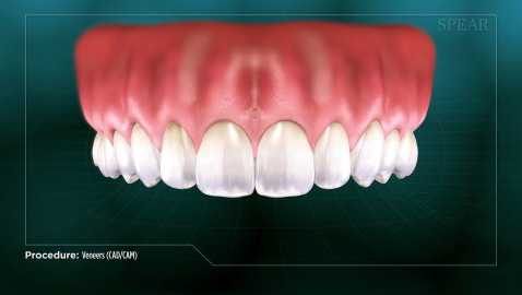 Facette-dentaire-4