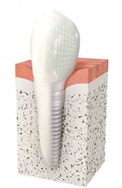 Implant dentaire Pontault-Combault