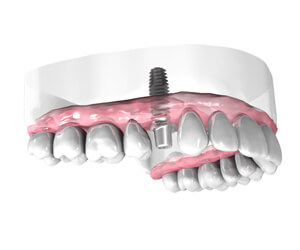 Mise-en-place-de-l-implant-dentaire-Implantologie