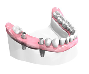 Mise-en-place-des-implants-dentaires-Implantologie