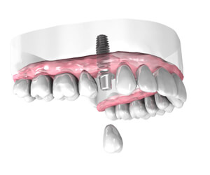 Pose-d-une-couronne-dentaire-sur-implant-Implantologie