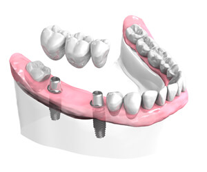 Pose-dun-bridge-ceramique-sur-implants-Implantologie
