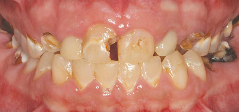 Les conséquences du non-remplacement des dents extraites ou absentes –  L'Information Dentaire